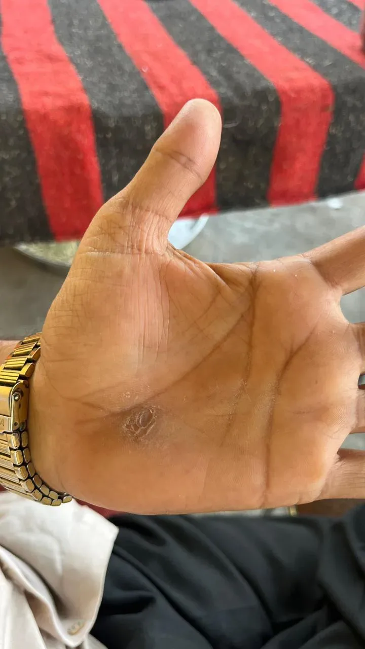 Calloused palm from cane use
